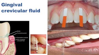 Gingival Cervicular Fluid [upl. by Sergius]