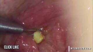 Worst Tonsil Stones Giant Tonsilloliths amp Stone Removal Documentary [upl. by Ylellan]