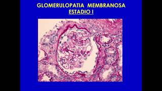 Focal Segmental Glomerulosclerosis  Beyond pathology Should genetics guide our intervention [upl. by Nhguavahs]