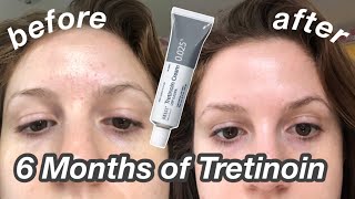 6 Month TretinoinRetinA Update Before amp After  My Current Skincare Routine [upl. by Yelrebmik]