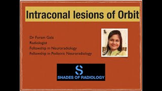 Intraconal lesions of Orbit Simplified [upl. by Lerud]