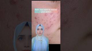 Acne Rescue plan Discover the most effective medications to treat acne trending viralshorts [upl. by Aleka]