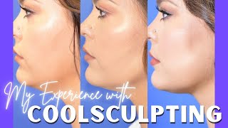 My Experience with CoolSculpting  QampA and Results [upl. by Niwred]