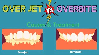 Overjet vs Overbite Deep Bite  EXPLAINED IN 3 MINUTES [upl. by Eliak709]