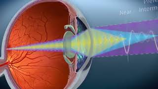 TRIFOCAL – Alcon PANOPTIX [upl. by Hoyt]