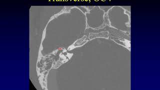 Temporal Bone Pathology 10 Trauma [upl. by Applegate]