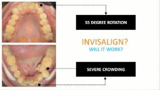 Dr Ibrahim Invisalign Case Review Rotations With AcceleDent [upl. by Adiaz]