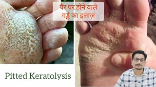 Pitted Keratolysis  Erythrasma  पैर पर होने वाले गड्ढे का इलाज़ fungalinfection fungalinfections [upl. by Freyah]