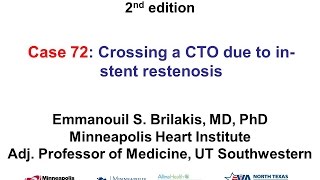 Case 72 Manual of CTO Interventions  Stent quotcrushquot for instent CTO [upl. by Nahrut]