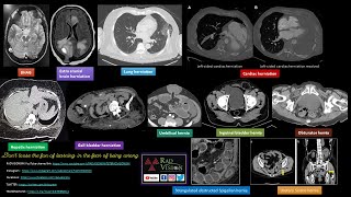 IMAGING IN HERNIAS CASE SPECTRUM [upl. by Thurman]