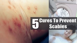 Scabies Rash 5 Effective Natural Remedies For Scabies  By Top 5 [upl. by Bathesda987]