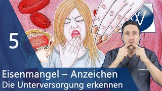 5 typische Eisenmangel Anzeichen von Blässe trockene Haut amp Haarausfall bis Müdigkeit amp Blutarmut [upl. by Hpesoj]