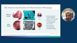 Rhinosinusitis With Nasal Polyps From Pathophysiology to Management [upl. by Selden]