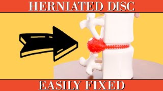 Herniated Disc Clearly Explained amp Easily Fixed [upl. by Aneras]