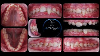 Class III with Traumatic occlusion  Full Case  DrAwfa [upl. by Voltmer]