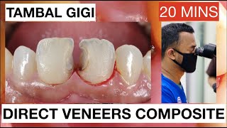 Step by Step Direct Veneers Composite Anterior Multiple Cases 20mins  General Dentist Griya RR [upl. by Ecyla]