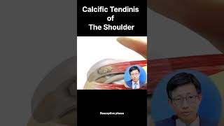 Understanding Calcific Tendinitis Stages Symptoms and Treatment Options 석회성 건염의 이해 단계 증상 및 치료 방법 [upl. by Drislane]