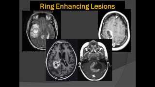 Brain Scans Lord of the Ring Enhancing Lesions 101 [upl. by Doti825]