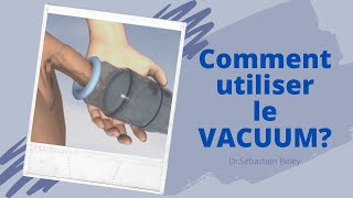 Dr Sébastien Beley Comment utiliser le vacuum [upl. by Atims534]