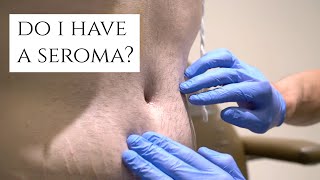 What is a Seroma  Fluid Build Up After Surgery  Symptoms and Treatment  Dr Daniel Barrett [upl. by Ahsiekit]