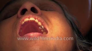 Root Canal treatment in India [upl. by Lehcar]