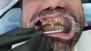 Teeth stain removal with Airflow [upl. by Cowen993]