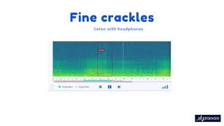 Lung sounds  fine crackles [upl. by Nabroc]