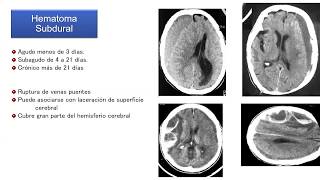 Traumatismo CraneoencefÃ¡lico [upl. by Javier]