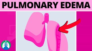 Pulmonary Edema Medical Definition  Quick Explainer Video [upl. by Phelgon]