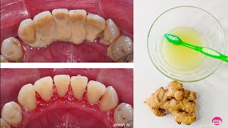 How to Remove Tartar from Teeth at home naturally  Natural Ways to Remove Tartar Buildup [upl. by Yerot]