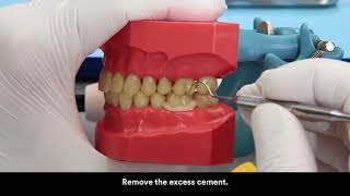 3M RelyX Unicem 2 clicker cementation zirconia crown [upl. by Dinesh]