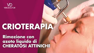 Crioterapia rimozione con azoto liquido di cheratosi attiniche [upl. by Eniad]