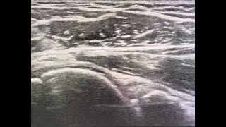 Ultrasound guided glenohumeral joint needle placement posterior approach [upl. by Putscher548]