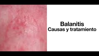 Balanitis Causas y tratamiento  Cura de la balanitis [upl. by Nylinej550]