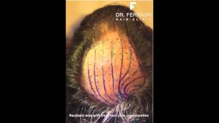 Haartransplantation Haarverpflanzung FUT Tonsur 3644 GraftsFUs [upl. by Fern]