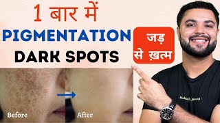 Pigmentation Melasma amp काले धब्बे Dark Spots होंगे जड़ से ख़त्म 1 बार में [upl. by Elianore610]