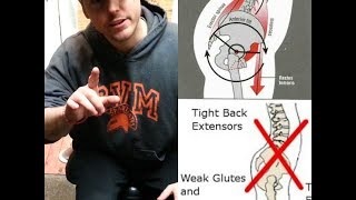 How To Fix Anterior Pelvic Tilt  NEVER SEEN SOLUTIONS  Shorter Leg amp Orthotics Considerations [upl. by Lewison]