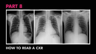 Diaphragms and Pleural Effusion  How to Read a Chest XRay Part 8  MEDZCOOL [upl. by Nivlem]