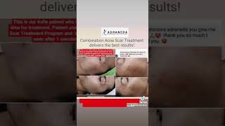 Synergistic Acne Scar Treatment  Subcision TCA CROSS RF Fractional PRP Fillers [upl. by Wiltsey893]