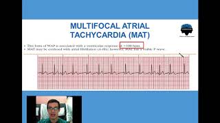 9 Taquicardia Multifocal Atrial [upl. by Angelica]