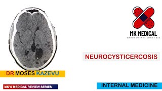 Neurocysticercosis [upl. by Elbertine946]