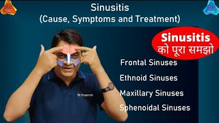 Sinusitis on Sinuses  Types and Treatment By Dr Puspendra [upl. by Larson]