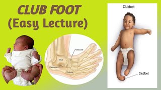 CLUB FOOTTALIPES EQUINOVARUSEpidemiology etiology risk factors classification and Management [upl. by Edora]