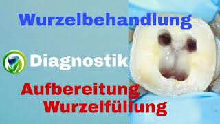 Wurzelbehandlung  Ablauf Diagnostik  Wurzelkanalaufbereitung  Wurzelfüllung [upl. by Odlanier904]