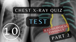 Can You Pass This Quiz Questions and Answers Part 2  10 Essential Chest Xrays xray respiratory [upl. by Odla91]