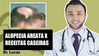 Alopecia Areata Receitas caseiras funcionam  Dr Lucas Fustinoni [upl. by Lleroj]