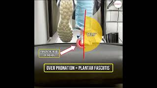 Discover how over pronation leads to Plantar fasciitis Get a grip on your foot health now FootCar [upl. by Hanna]