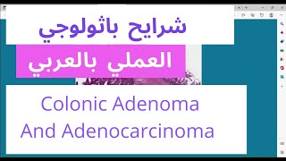 Colon histology  colonic adenocarcinoma  Tubulovillous adenoma low grade and high grade [upl. by Nnylkcaj]