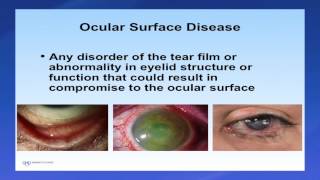 Introduction to Scleral Lenses [upl. by Atcele]