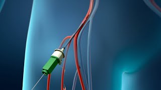 Coronary Angioplasty Femoral Access [upl. by Attener]